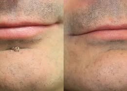 Invisible Patches for Face