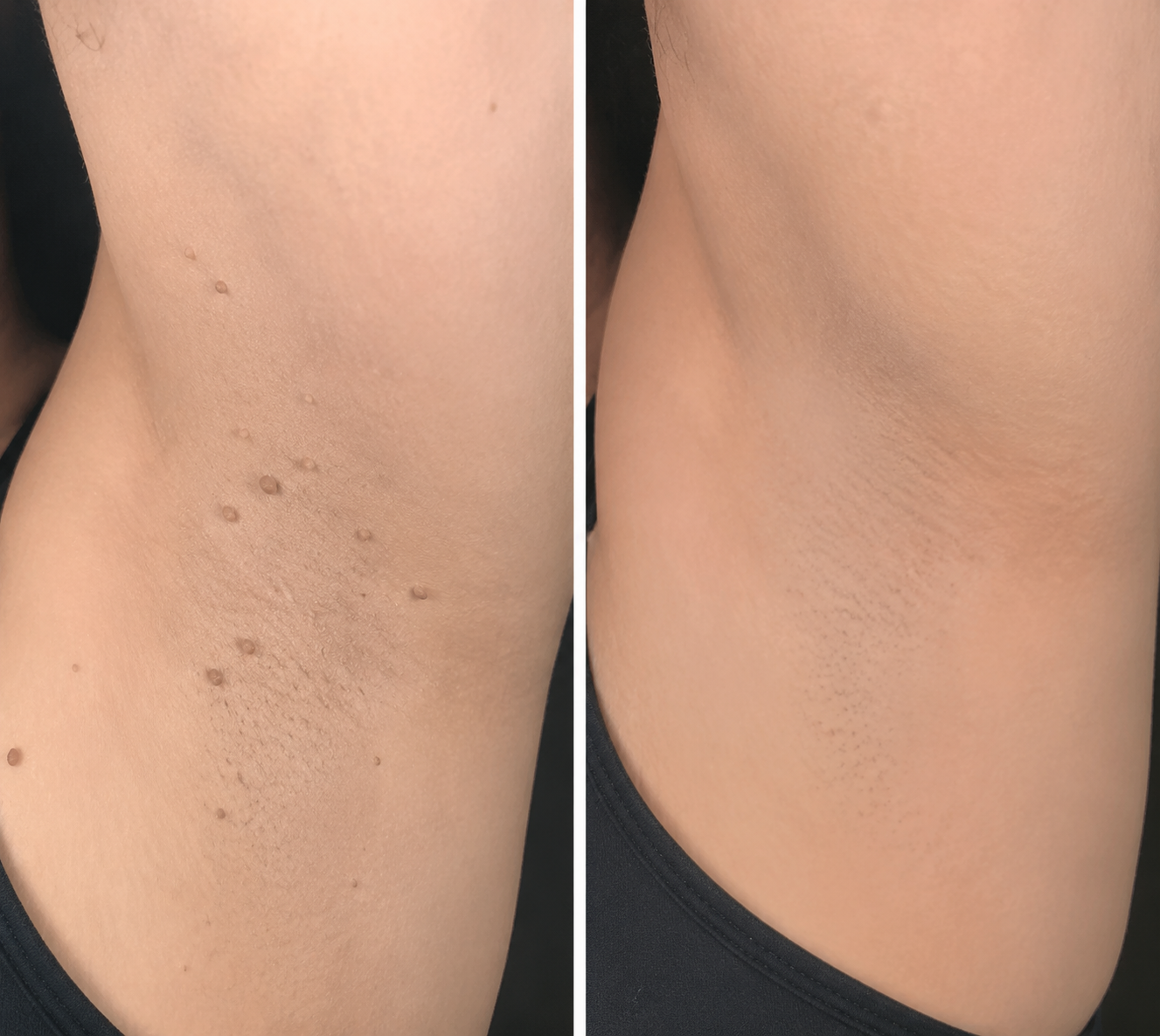 Invisible Patches for Face