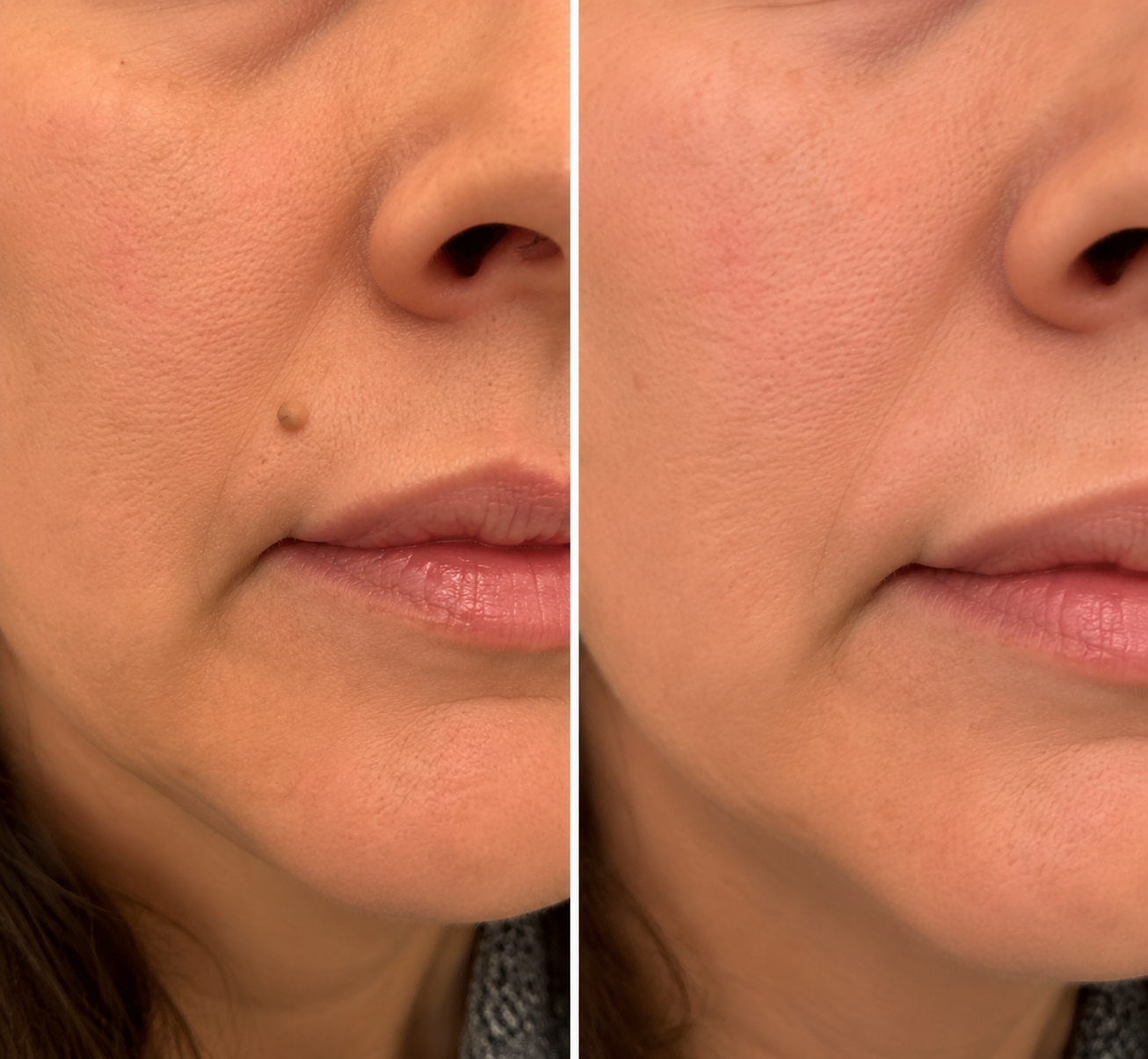 Invisible Patches for Face